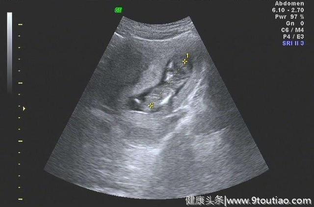 怀孕3个月，看懂B超单上这两个数据，胎儿就没有什么小秘密了