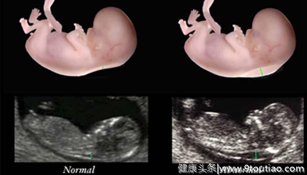 怀孕3个月，看懂B超单上这两个数据，胎儿就没有什么小秘密了