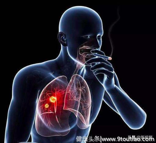 “肺要健康”，这是一篇肺癌科普干货！