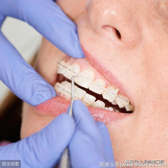 成年人是否还可以矫正牙齿、解除错牙合畸形