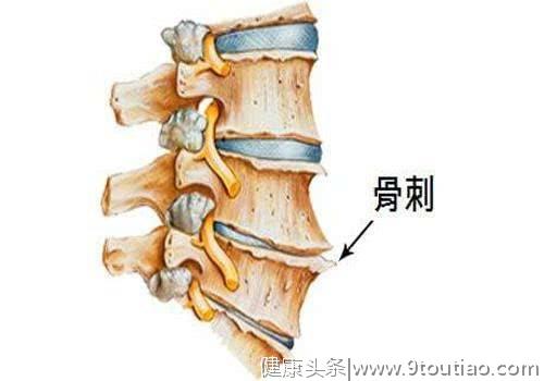 有多少人知道骨质增生就是骨刺