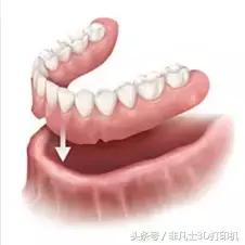 3D打印技术在齿科行业的应用