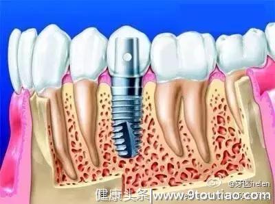 Helen齿科中心——导致种植牙失败的原因有哪些？