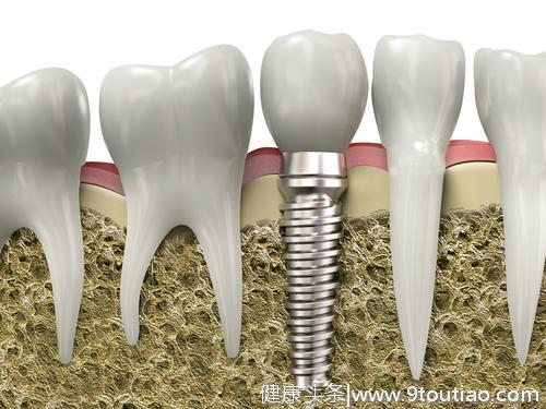 种植牙如何避坑？听听专家怎么说