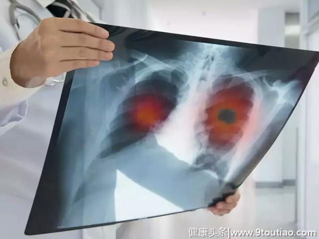 肺癌，许多病人还能活得更久一点！怎么做？