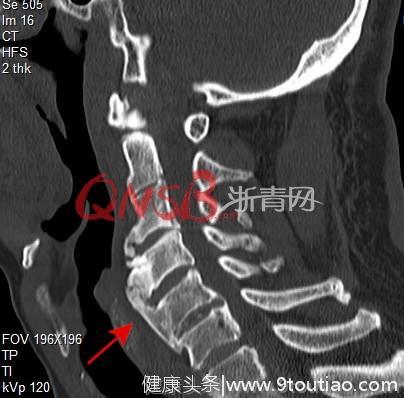 浙江男子吞咽疼痛还有异物感，以为得了食道癌，没想到问题出在颈椎上