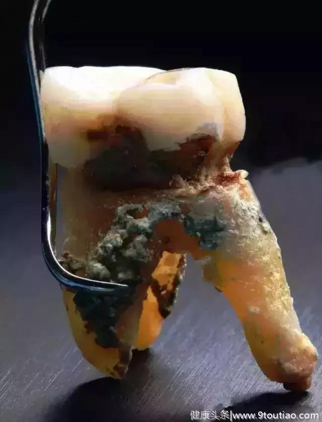 牙医给自然脱落的牙齿拍微距照片！万万没想到