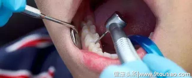 医生，你说的补牙，怎么成了“钻”牙了？