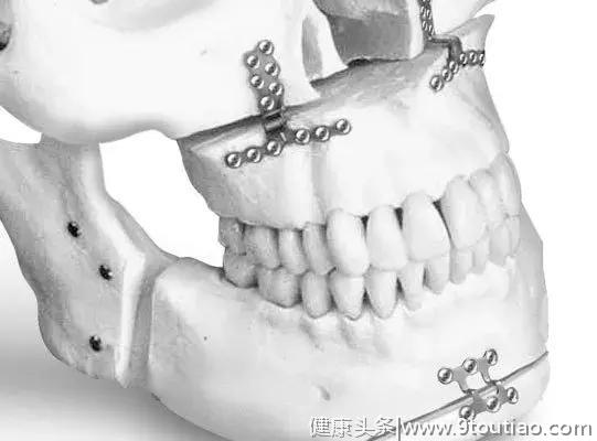 牙医的“换脸术”是怎么操作的？