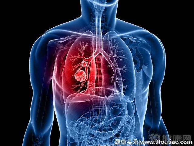 每年63万人死于肺癌！肺癌到了晚期，可以尝试放疗