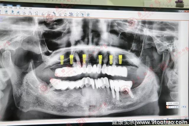 一位决定种牙的出租车司机，是什么让他决定修复多年的缺牙？