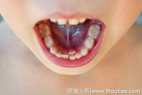 为什么孩子的乳牙更容易被蛀？