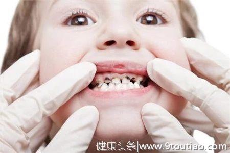 为什么孩子的乳牙更容易被蛀？