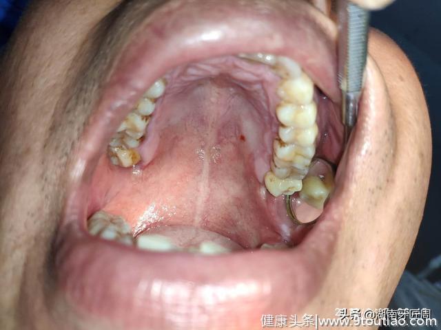 你以为你的牙齿很健康？看完这个病例或许会让你马上想去口腔医院