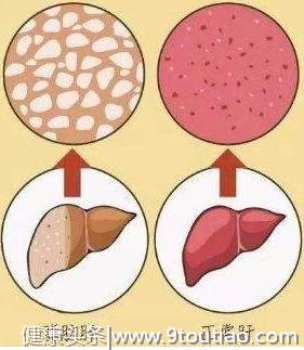 从脂肪肝演到肝癌只有四步，不可掉以轻心