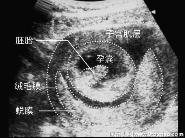 明明测出怀孕，6天后做B超却看不到孕囊，小心是生化妊娠
