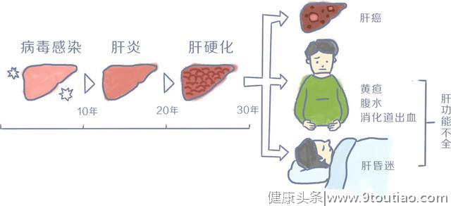 世界肝炎日：你的拖延症，可能会害死你