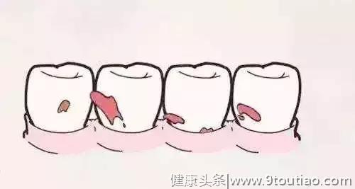 很多人牙齿小洞不补，大洞才补？小心牙齿蛀光光