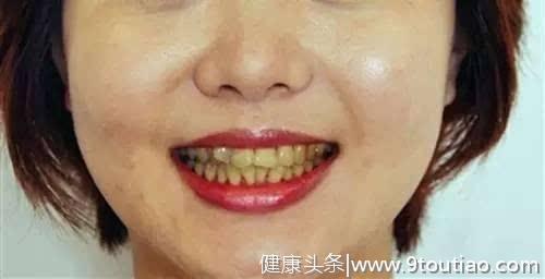为什么天天刷牙还是黄？医生：教你牙齿美白的各种姿势