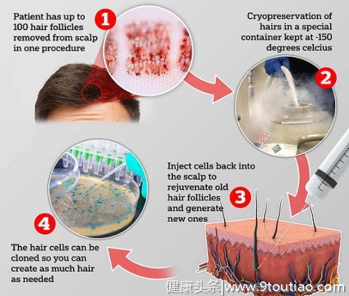 英国推出防脱发新疗法：冷冻自己的健康毛囊，脱发的时候再植入