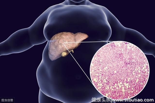 脂肪肝患者，身体出现出现这个症状，需筛查肝癌