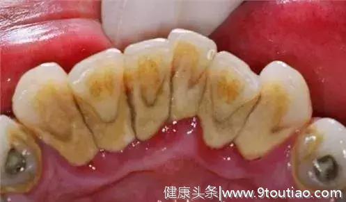 别不信！看看牙结石是如何一步步毁掉你的牙的？