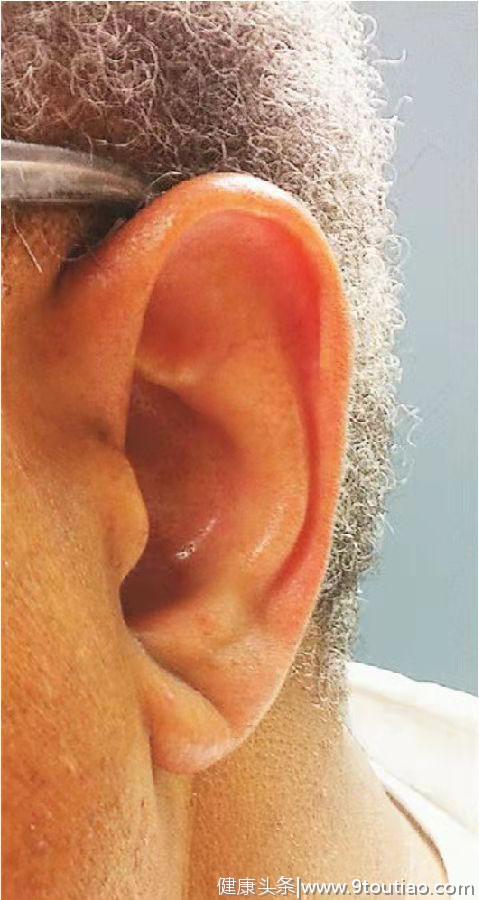 医生带您揭秘：耳垂上有褶皱，暗示有心脏病？