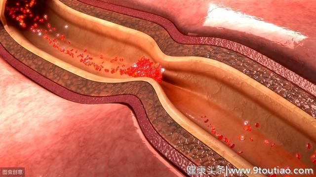 心脏造影正常就能排除心脏病？医生辟谣：并不能排除心脏病