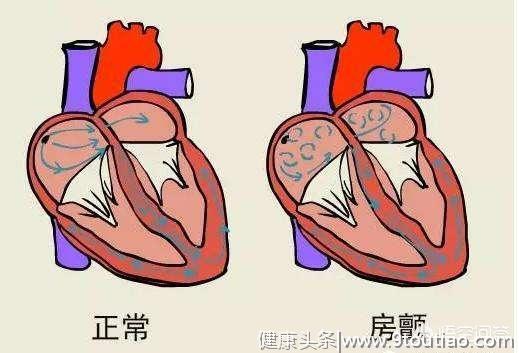 老年心脏病中，这三种心脏问题最常见，怎样应对？医生来为你支招