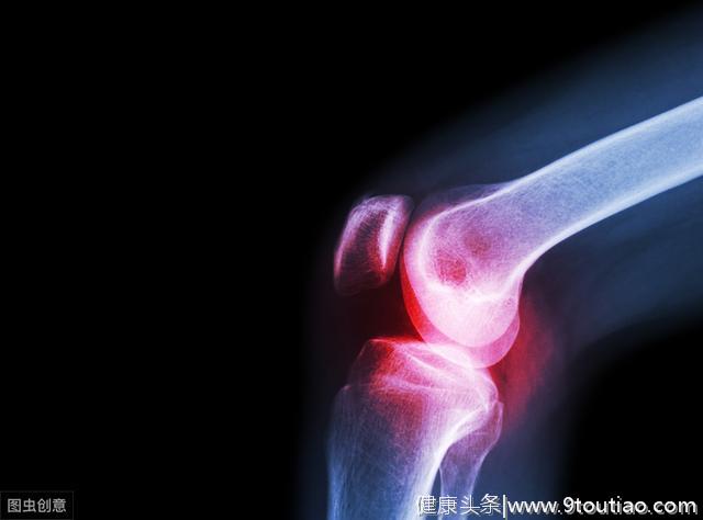 膝关节炎是如何缠上我们的膝盖的？怎样预防关节炎呢？