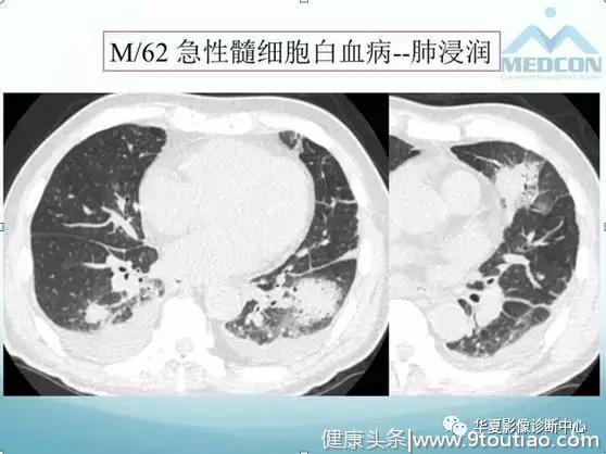 白血病肺部浸润的影像表现