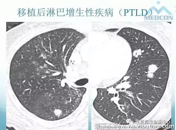 白血病肺部浸润的影像表现