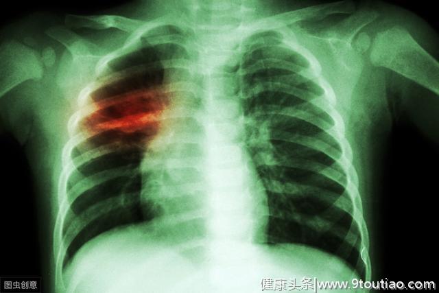 肺癌早期通常会有哪些变化？千万别错当感冒
