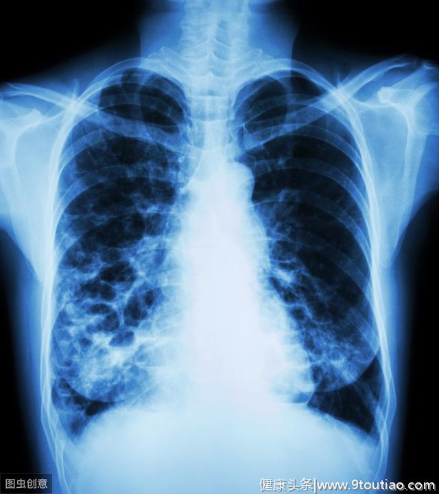 肺癌早期通常会有哪些变化？千万别错当感冒