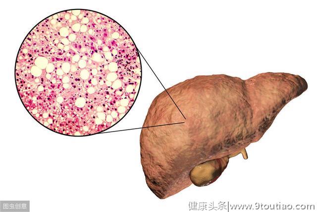 拉肚子也能拉出脂肪肝？医生：做好2件事，拒绝脂肪肝