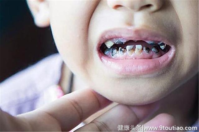 3岁半宝宝牙齿“全烂光”，这些坏习惯，是孩子烂牙的“帮凶”