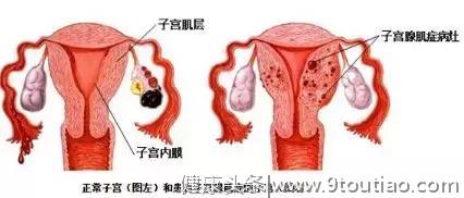 「一个腺肌症患者的自述」我把子宫切除后……