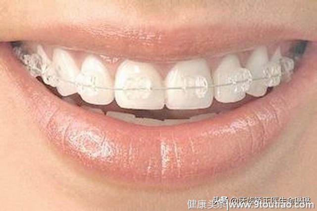 现在市面上四种牙套的优缺点：你适合哪一种？