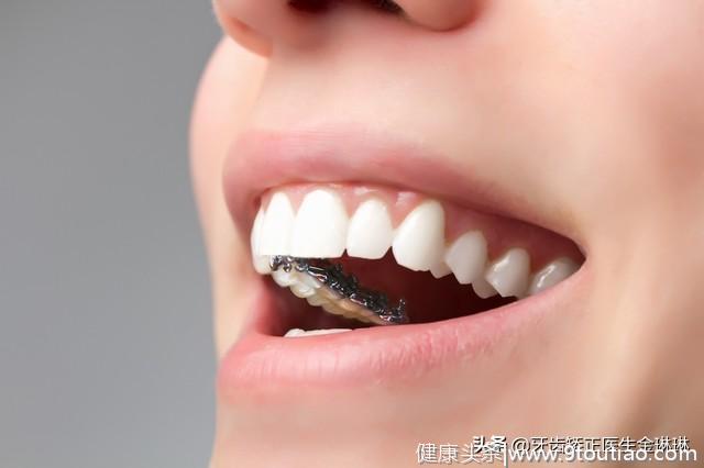 现在市面上四种牙套的优缺点：你适合哪一种？