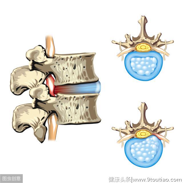 路医生说丨腰椎间盘突出症，有没有一劳永逸的「根治」方法？