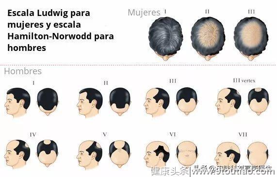 常见11种皮肤病讲解之「目前治疗脂溢性脱发最有效的三种方法」