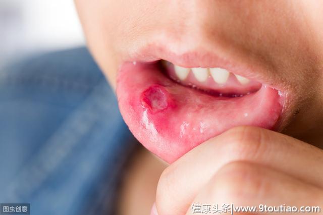 化疗造成口腔溃疡，吞咽口水都会剧烈疼，有什么办法缓解？
