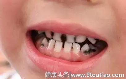 孩子的这20种牙颌畸形问题需要在12岁前解决