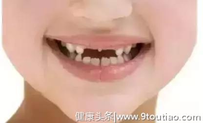 孩子的这20种牙颌畸形问题需要在12岁前解决