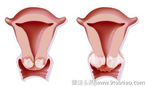 妇科炎症不能吃什么？中医治疗妇科炎症的食疗方有哪些？