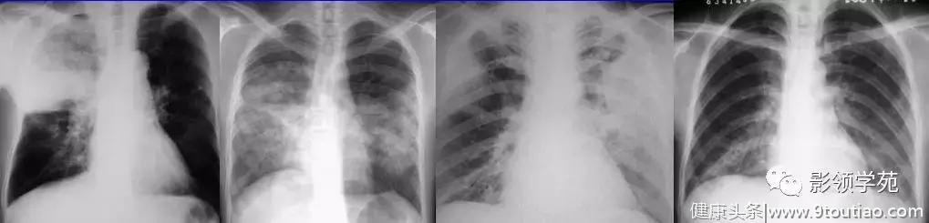 肺炎的影像诊断和鉴别诊断