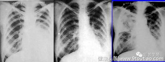 肺炎的影像诊断和鉴别诊断