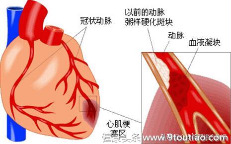 “心脏病”和“冠心病”是同一种病吗？心血管专家为你解答