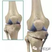 膝骨关节炎如何进行阶梯治疗？