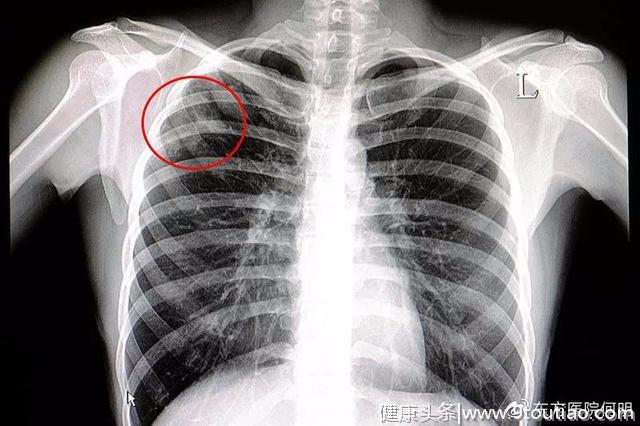 哪些咳嗽是”肺癌”的信号？